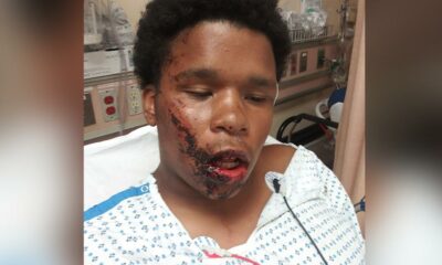 Bronx teenager Jahmel Leach suffered facial fractures after allegedly being tased by NYPD, his lawyer told CNN.